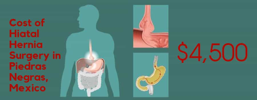 Cost of Hiatal Hernia Surgery in Piedras Negras, Mexico